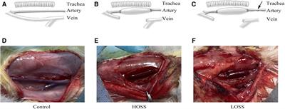 Oscillatory shear stress promotes vein graft intimal hyperplasia via NADPH oxidase-related pathways